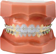 braces
