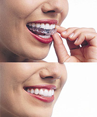 Invisalign