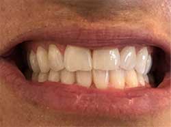 teleorthodontics front teeth together