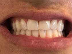 teleorthodontics front teeth together
