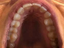 teleorthodontics top teeth