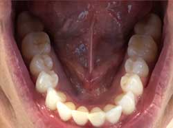 teleorthodontics bottom teeth