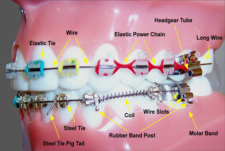 What role do elastics (rubber bands) play in orthodontics? - Dr